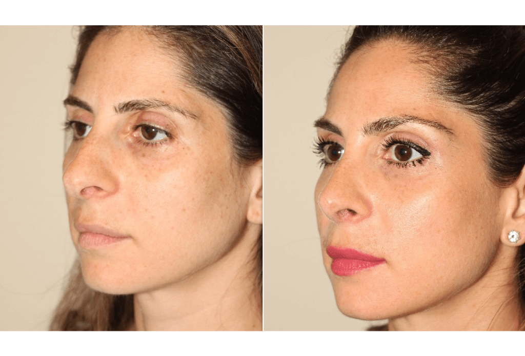 Rhinoplasty Dr Denton