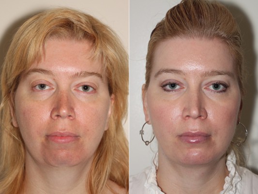 Facial Liposuction Vancouver By Cosmetic Surgeon Dr. Denton