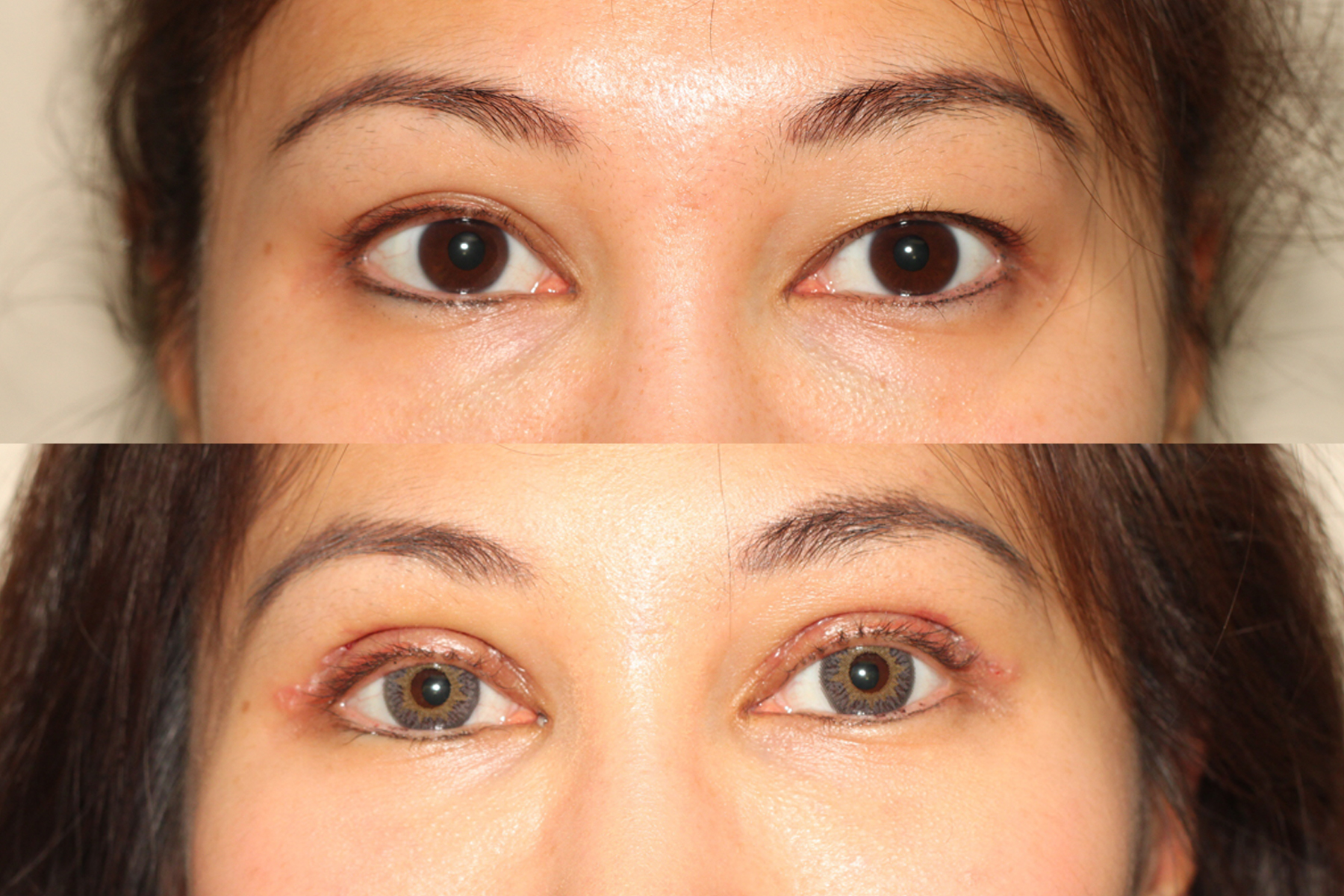 How long does it usually take to recover from upper eyelid surgery?