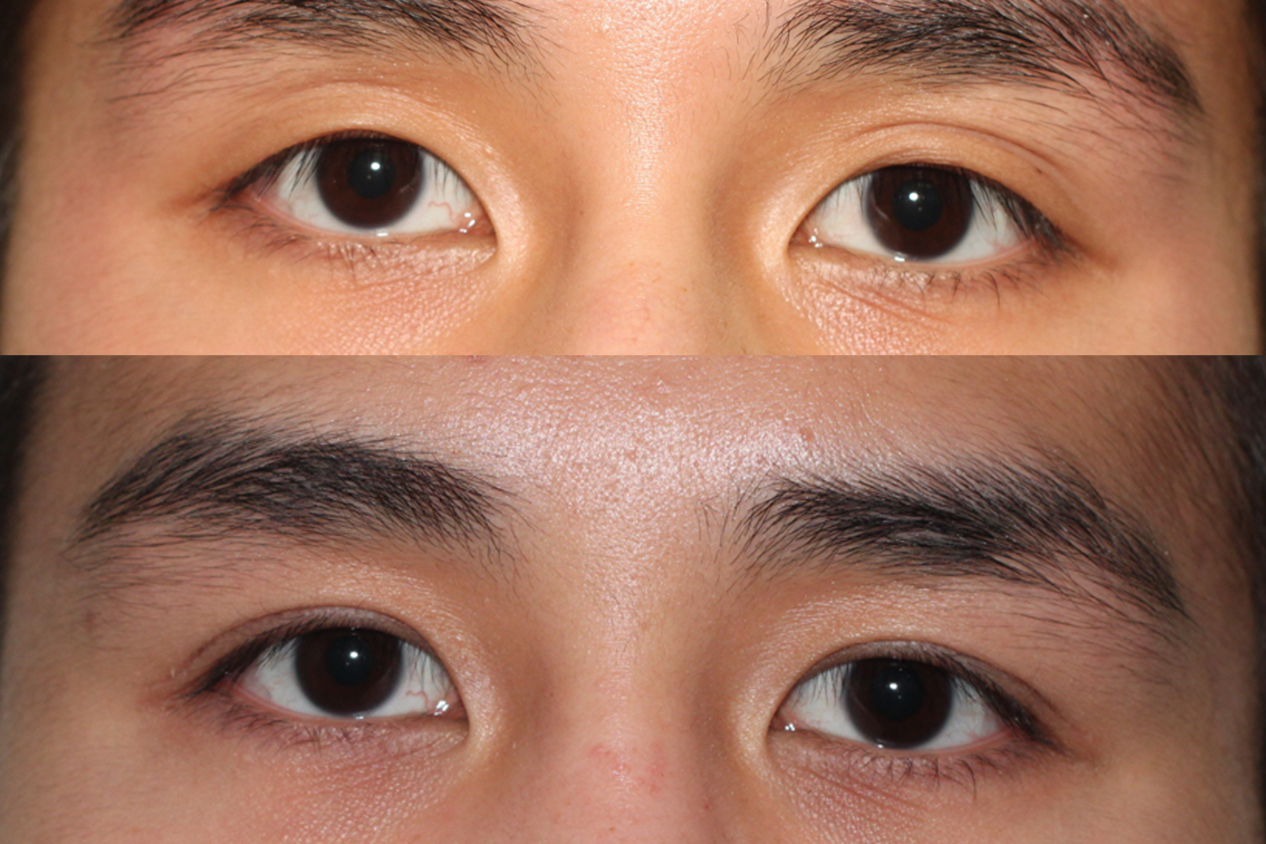Double Eyelid Surgery Asian Eyelid Result Of Double Eyelid Surgery