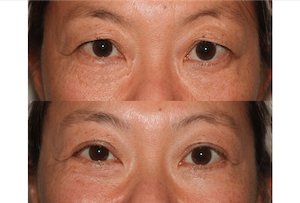 Dr. Denton Asian blepharoplasty before and after photo of a female patient