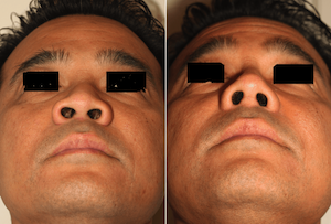 Dr. Denton Asian rhinoplasty before and after photo of a male patient