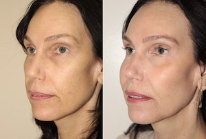 Dr. Denton cheek implant before and after photo of a female patient