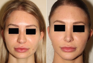 Dr. Denton rhinoplasty and chin implant before and after photo of a female patient