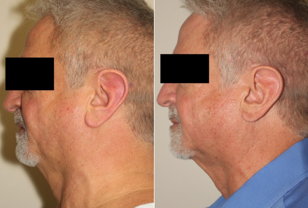 Dr. Denton Otoplasty before and after - ear lobe reduction