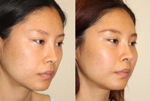 Dr. Denton cheek implant before and after photo of a female patient