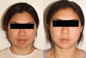 Dr. Denton liposuction before and after photo of a female patient