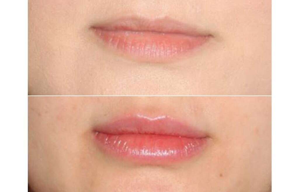 Volbella – A New Hyaluronic Acid Derived Filler