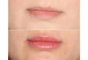 Dr. Denton lip filler before and after photo of a female patient