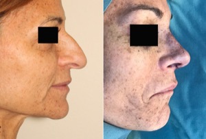 Dr. Denton Rhinoplasty before and after photo of a female patient