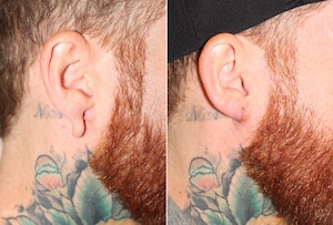 Dr. Denton Otoplasty before and after - ear lobe repair