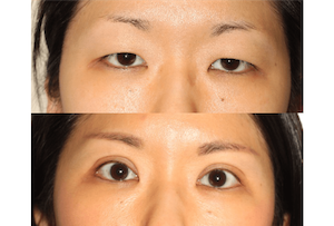 Dr. Denton Asian blepharoplasty before and after photo of a female patient