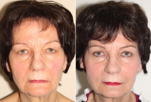 Dr. Denton blepharoplasty before and after photo of a female patient