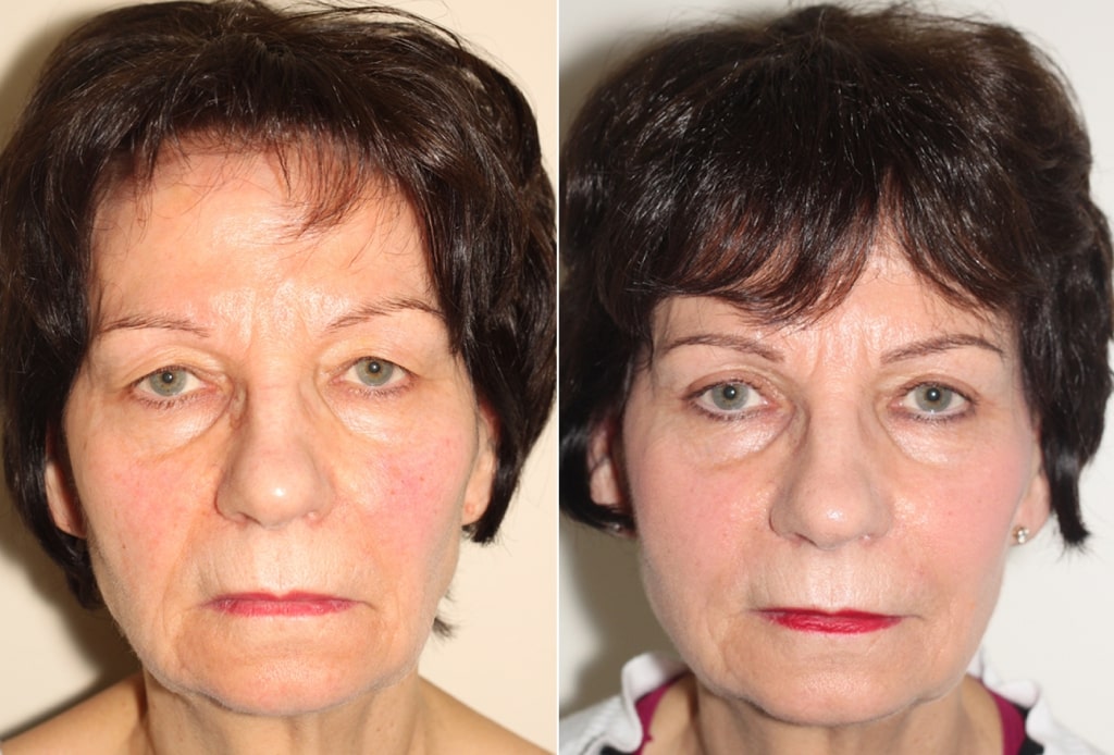 Dr. Denton blepharoplasty before and after photo of a female patient