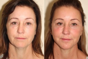 Dr. Denton facelift before and after photo of a female patient