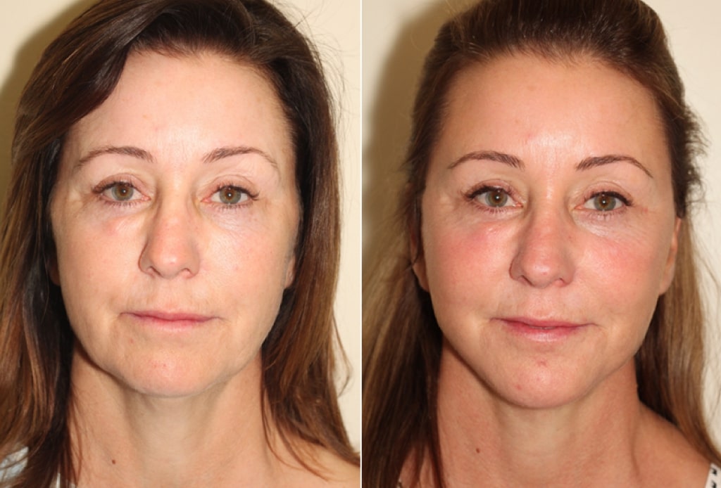 Dr. Denton facelift before and after photo of a female patient