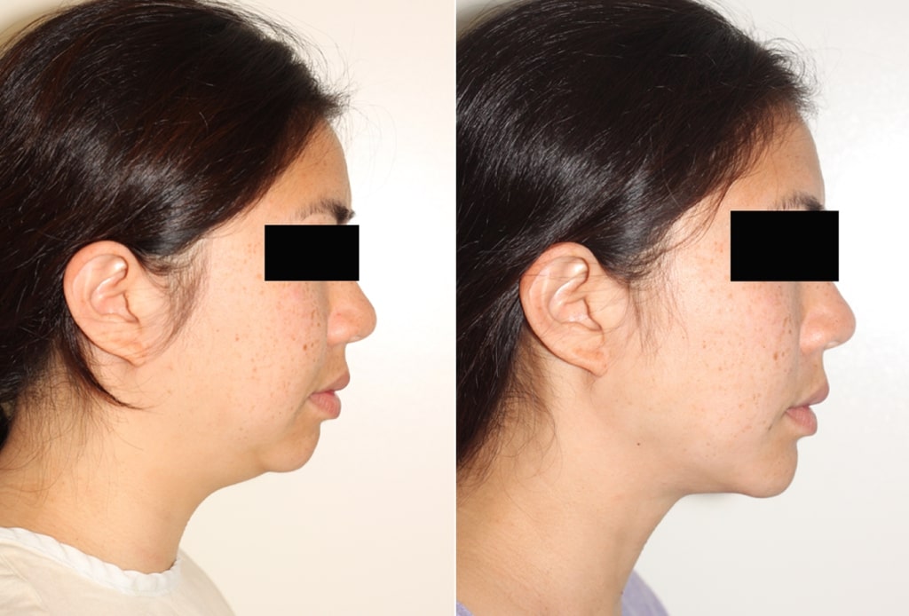 Dr. Denton chin implant before and after photo of a female patient