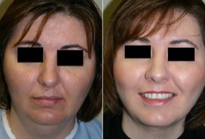 Dr. Denton liposuction before and after photo of a female patient