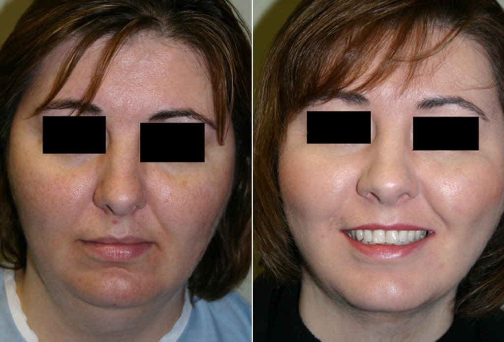 Dr. Denton liposuction before and after photo of a female patient