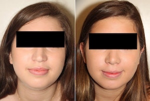 Dr. Denton Rhinoplasty before and after photo of a female patient