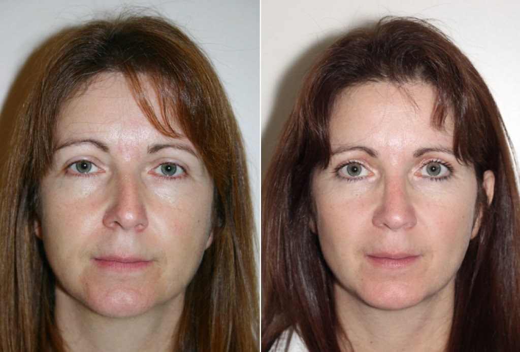 Dr. Denton Rhinoplasty before and after photo of a female patient