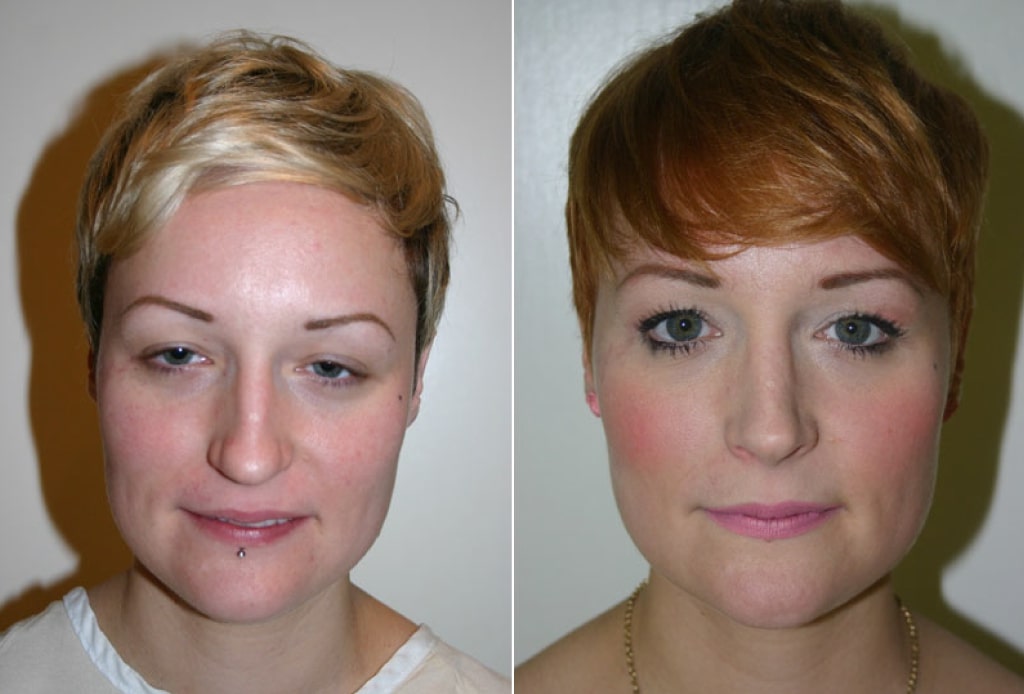 Dr. Denton Rhinoplasty before and after photo of a female patient