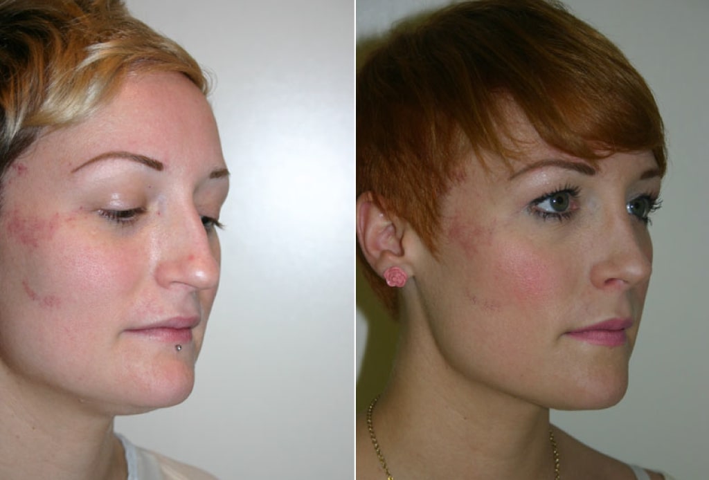 Dr. Denton Rhinoplasty before and after photo of a female patient