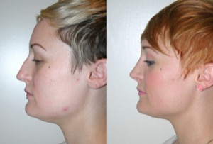 Dr. Denton Rhinoplasty before and after photo of a female patient