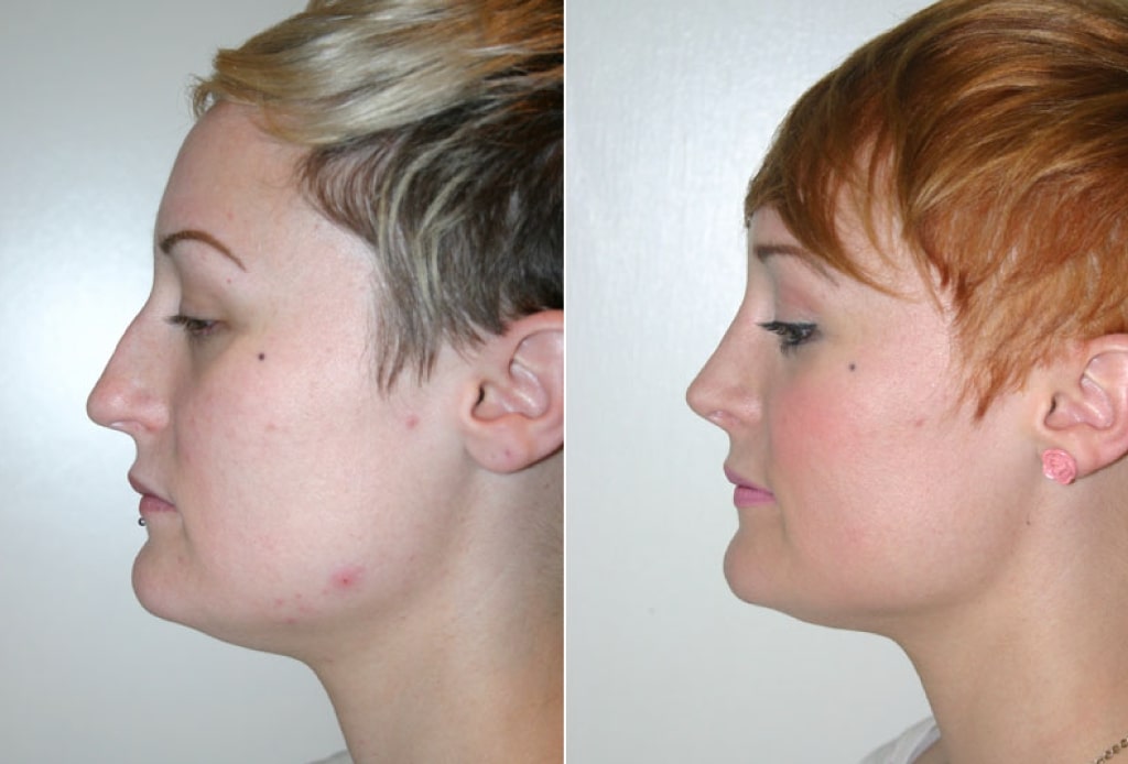 Dr. Denton Rhinoplasty before and after photo of a female patient