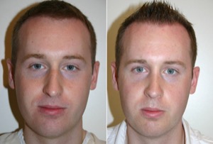 Dr. Denton Rhinoplasty before and after photo of a male patient