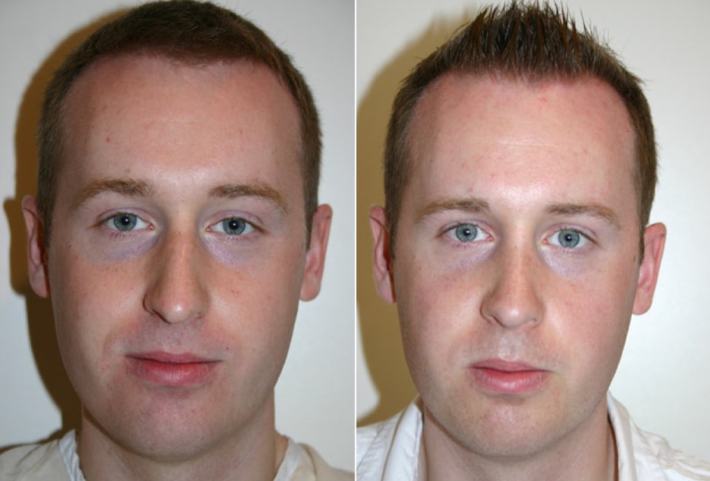 Dr. Denton Rhinoplasty before and after photo of a male patient