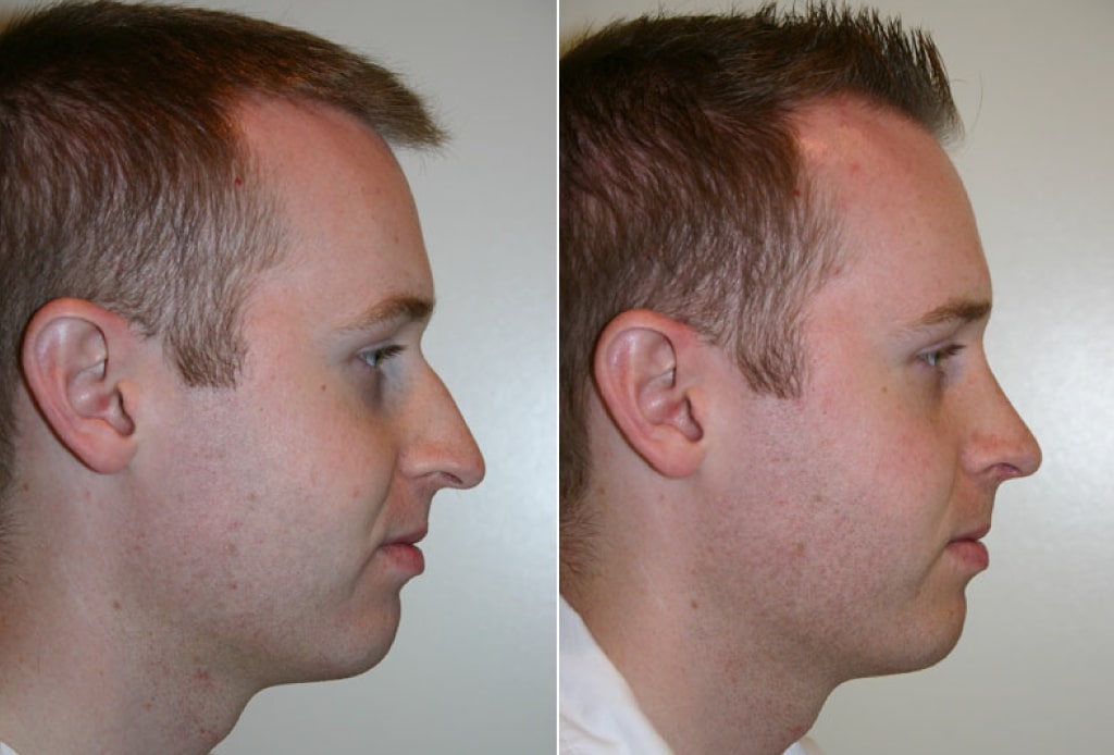 Dr. Denton Rhinoplasty before and after photo of a male patient