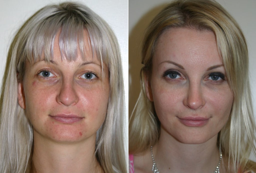 Dr. Denton Rhinoplasty before and after photo of a female patient