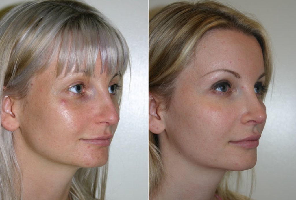 Dr. Denton Rhinoplasty before and after photo of a female patient