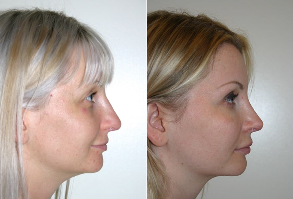 Dr. Denton Rhinoplasty before and after photo of a female patient