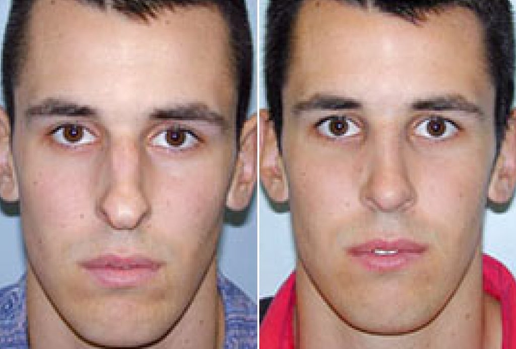 Dr. Denton Rhinoplasty before and after photo of a male patient