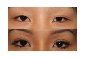 Dr. Denton Asian blepharoplasty before and after photo of a female patient