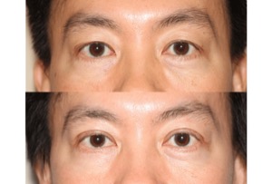 Dr. Denton Asian blepharoplasty before and after photo of a male patient