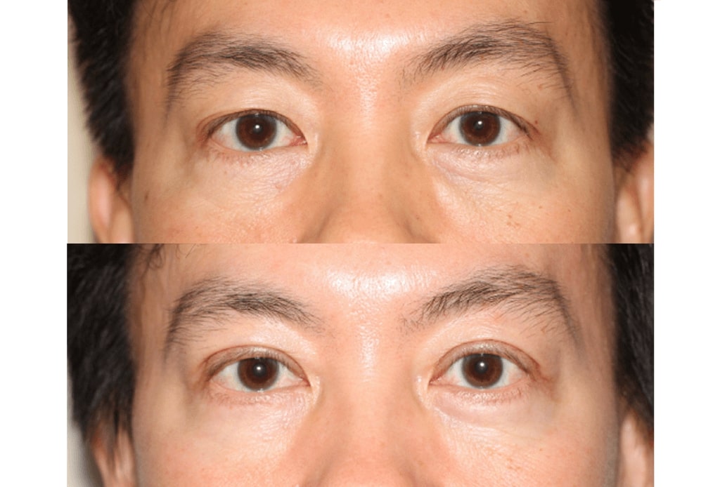 Dr. Denton Asian blepharoplasty before and after photo of a male patient