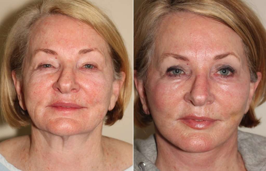 Facial Surgical Procedures You Can Combine With Your Facelift