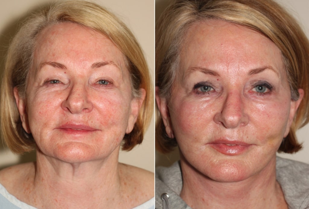 Dr. Denton facelift with additional facial surgical procedures before and after photo of a female patient