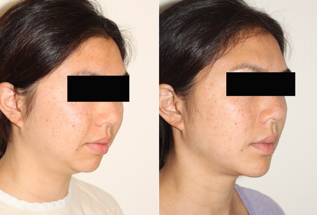 Dr. Denton chin implant before and after photo of a female patient