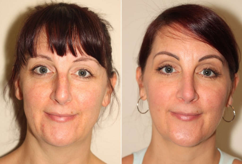 Dr. Denton liposuction and chin implant before and after photo of a female patient