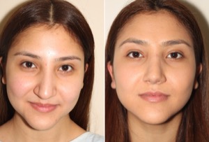 Dr. Denton Rhinoplasty before and after photo of a female patient