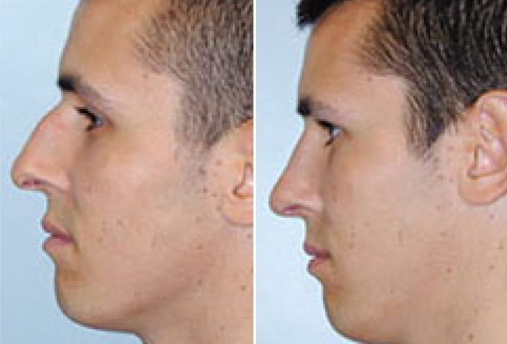 Dr. Denton Rhinoplasty before and after photo of a male patient