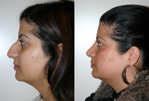 Dr. Denton Rhinoplasty before and after photo of a female patient