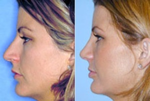 Dr. Denton Rhinoplasty before and after photo of a female patient