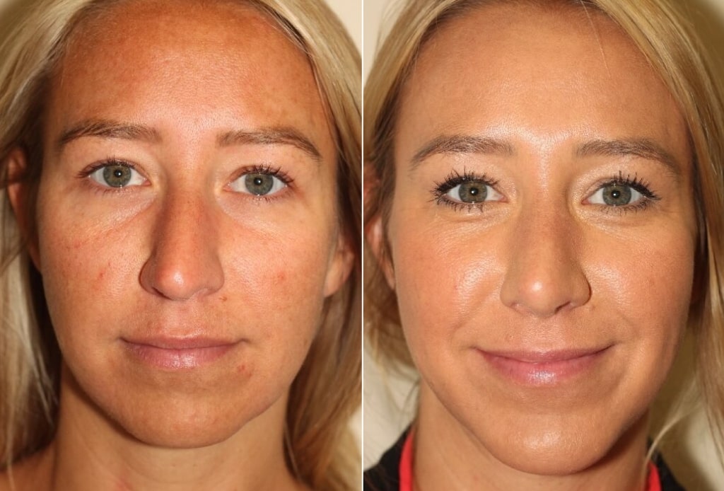 Dr. Denton Rhinoplasty before and after photo of a female patient