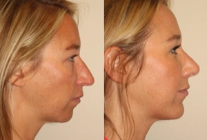 Dr. Denton Rhinoplasty before and after photo of a female patient