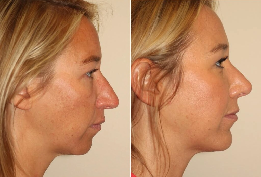 Dr. Denton Rhinoplasty before and after photo of a female patient